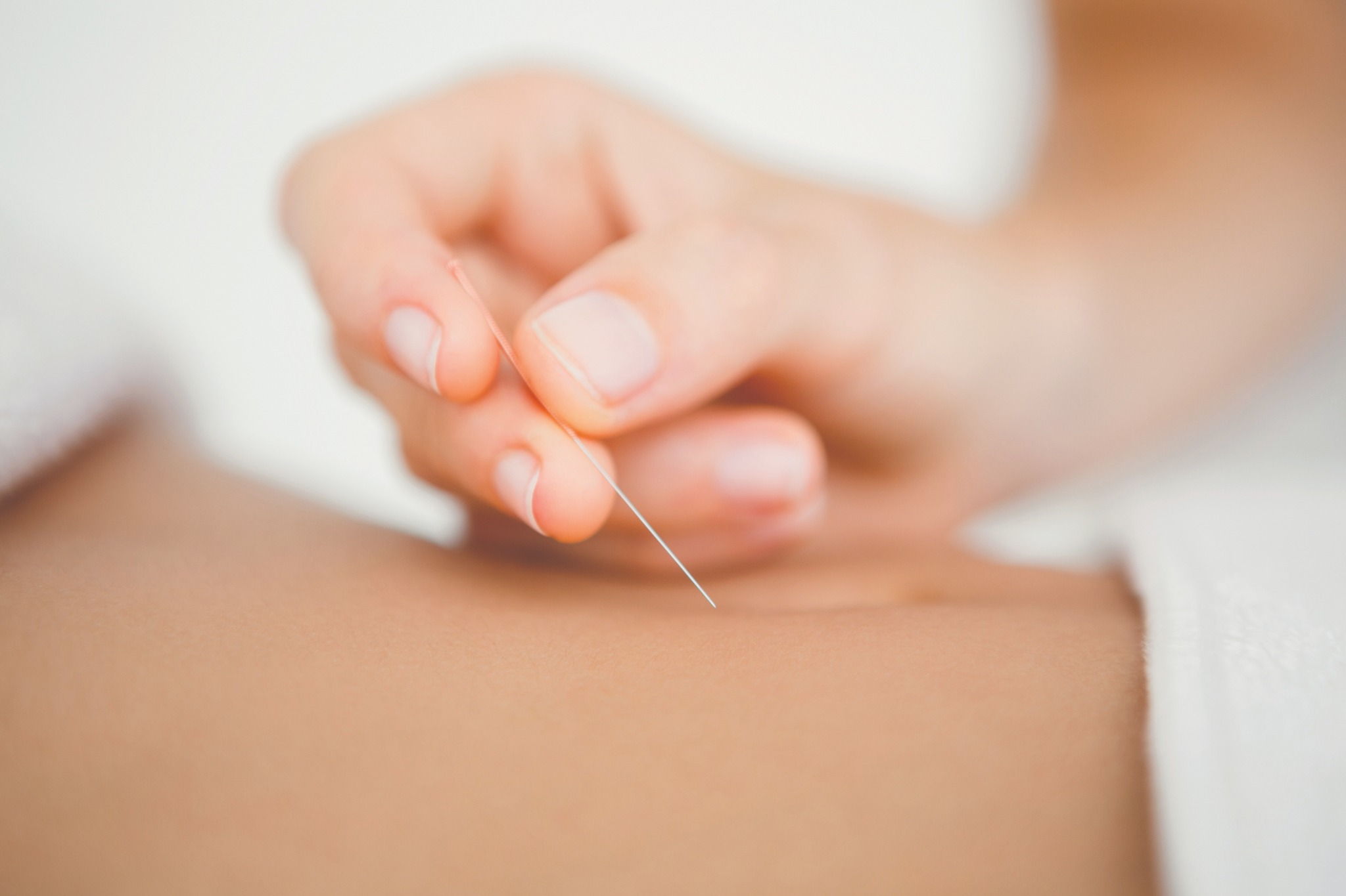 Dry needling treatment