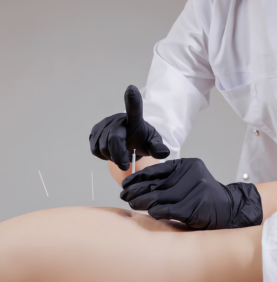 Dry needling treatment